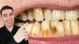 Das stärkste NATÜRLICHE MEDIZIN zur Entfernung von Zahnbelag