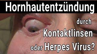 Hornhautentzündung durch Kontaktlinsen oder Herpes Virus?