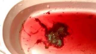 Morgellons sterben ab durch Zeolith-Wasser ?