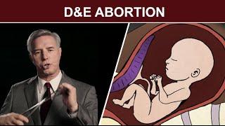 2nd Trimester Surgical Abortion: Dilation and Evacuation (D & E)